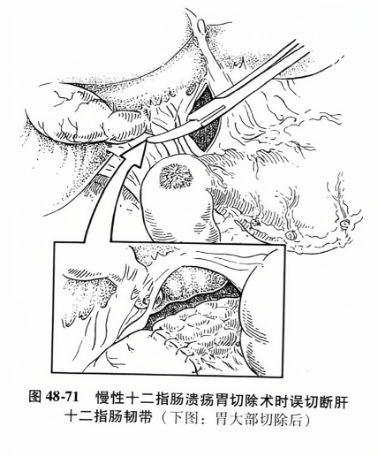 慢性十二指肠溃疡胃切除术时误切断肝十二指肠韧带(下图：胃大部切除后)