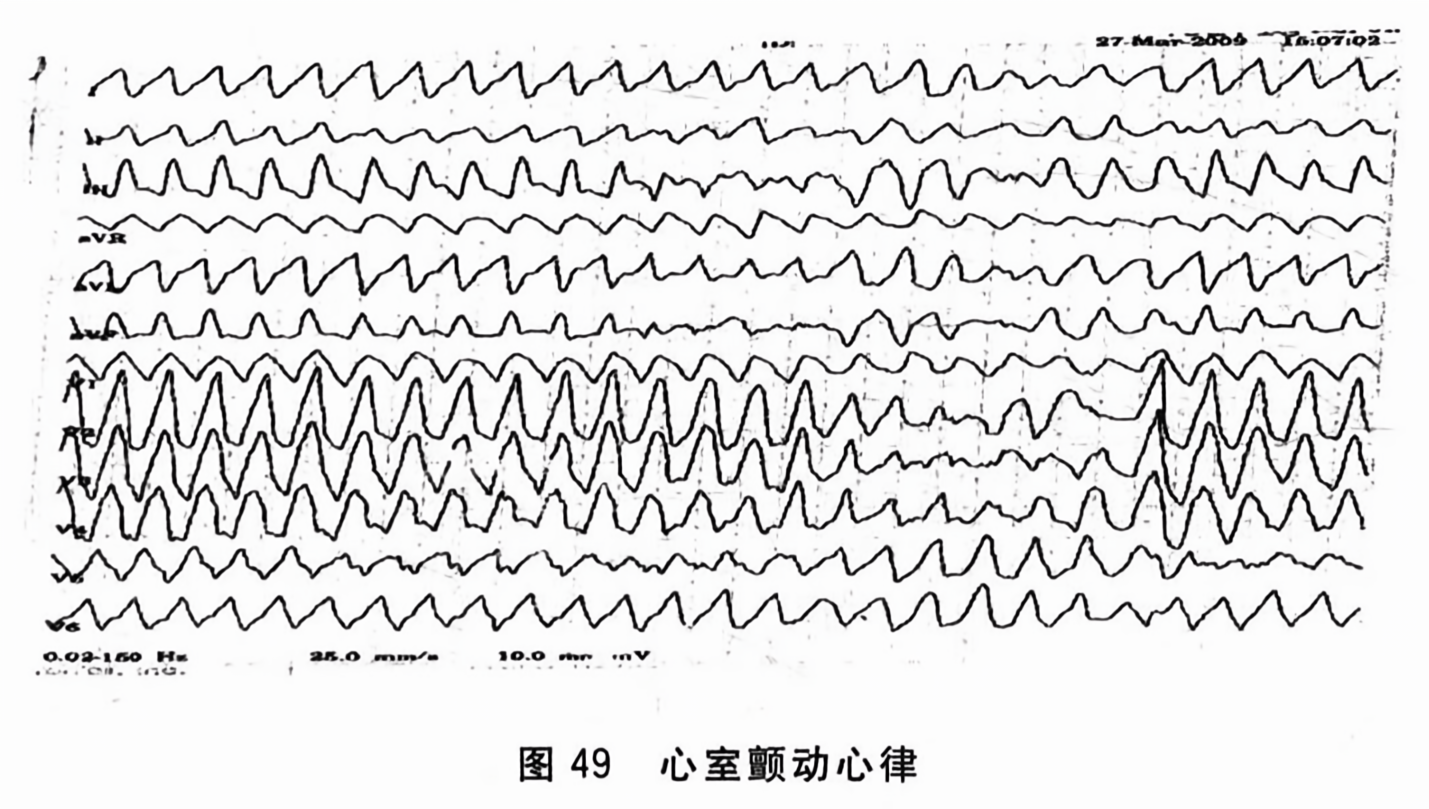 心室颤动心律
