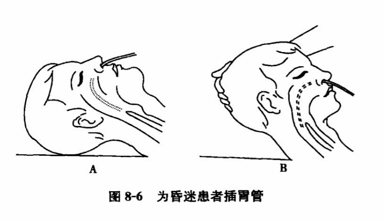 为昏迷患者插胃管