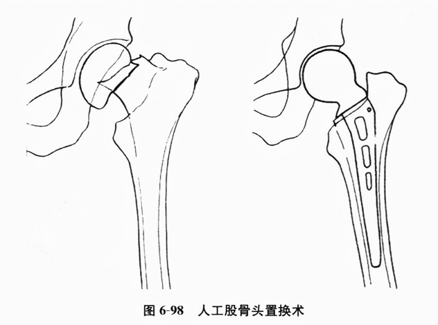 人工股骨头置换术