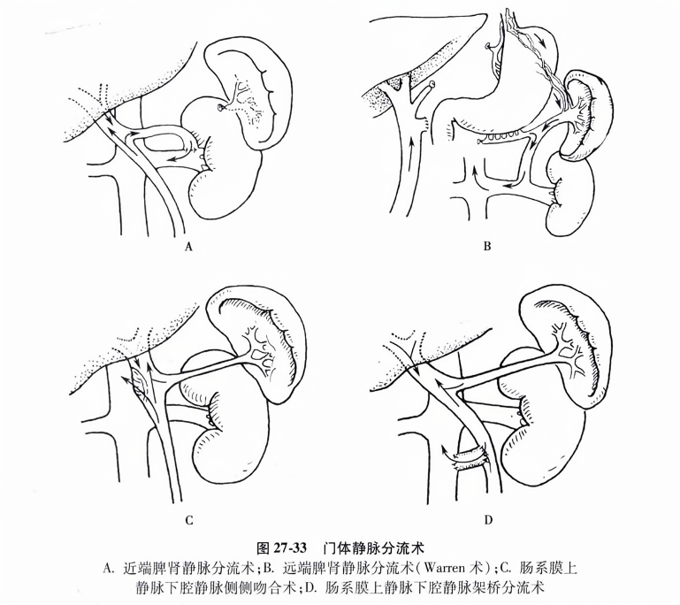 门体静脉分流术