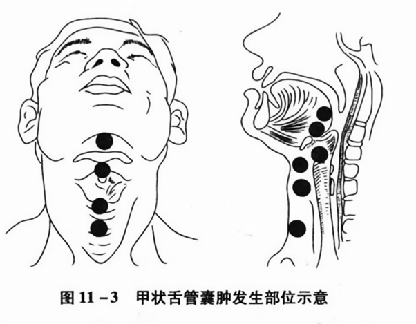甲状舌管囊肿发生部位示意