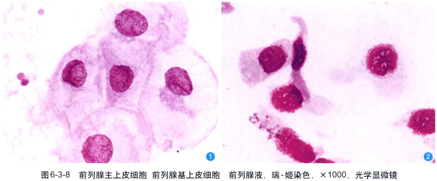 图6-3-8 前列腺主上皮细胞前列腺基上皮细胞前列腺液,瑞-姬染色,×1000,光学显微镜