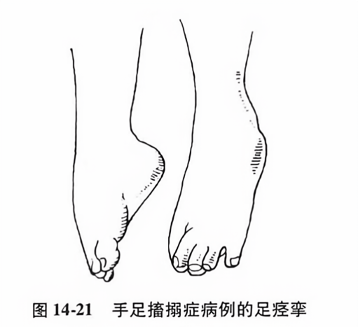 手足搐搦症病例的足痉挛