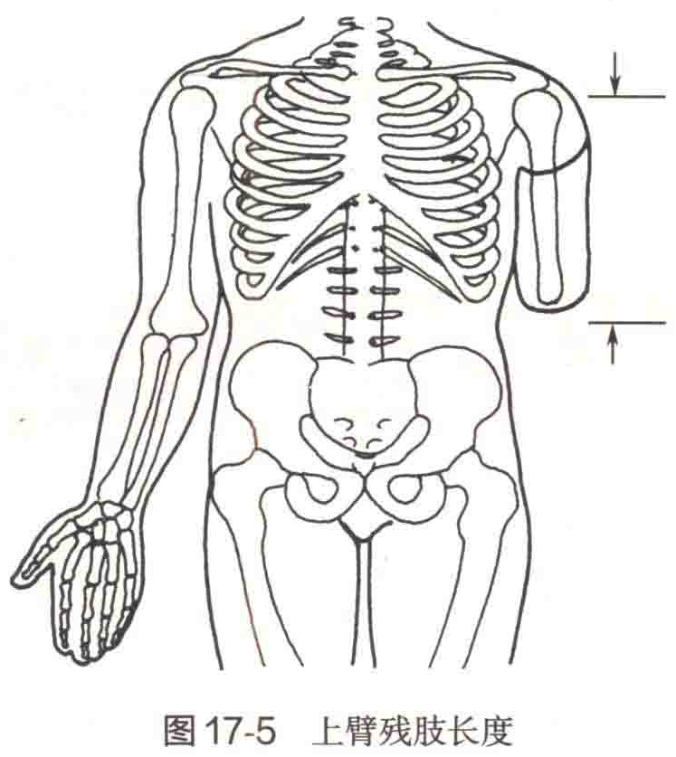 图17-5 上臂残肢长度