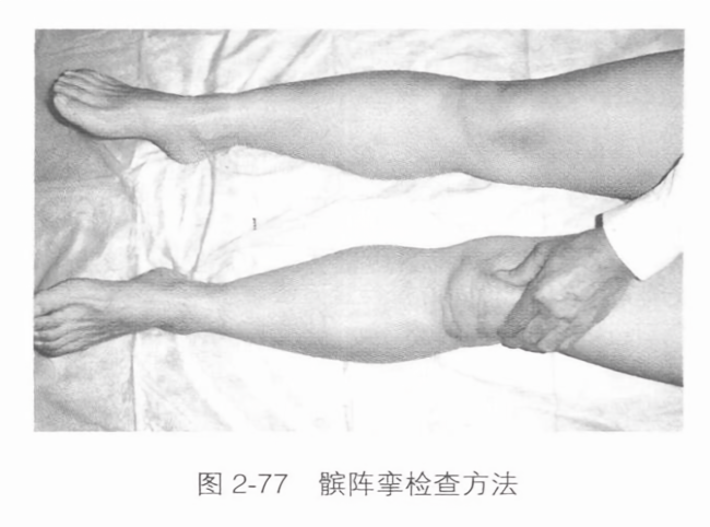 髌阵挛检查方法
