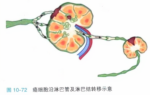癌细胞沿淋巴管及淋巴结转移示意