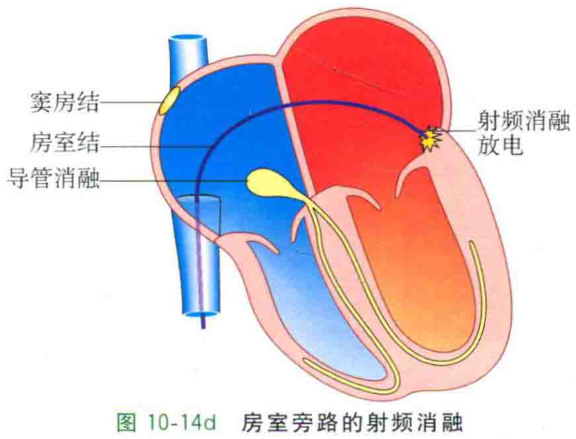 图10-14d 房室旁路的射频消融