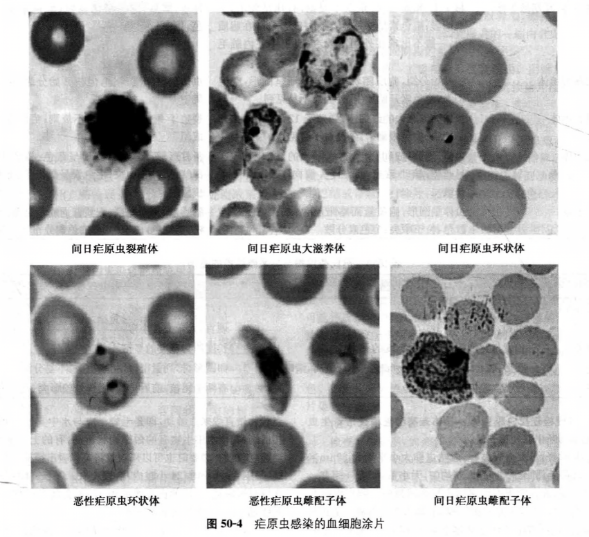 疟原虫感染的血细胞涂片 疟原虫感染的血细胞涂片