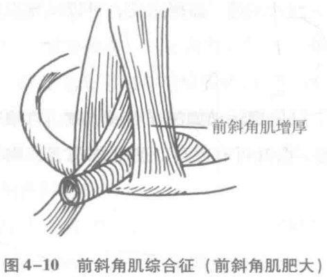 图4-10 前斜角肌综合征(前斜角肌肥大)