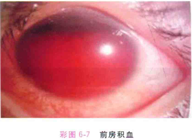 彩图 6-7 前房积血
