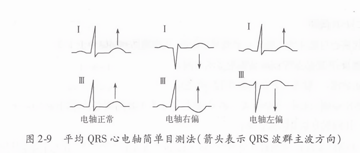平均qrs心电轴简单目测法(箭头表示qrs波群主波方向