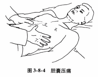 胆囊压痛