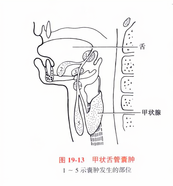 甲状舌管囊肿