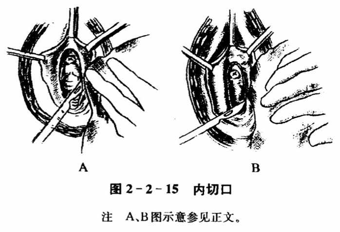 内切口