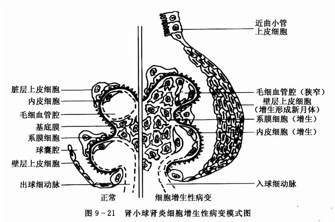 肾小球肾炎细胞增生性病变模式图