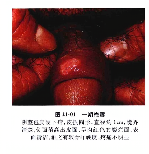 一期梅毒