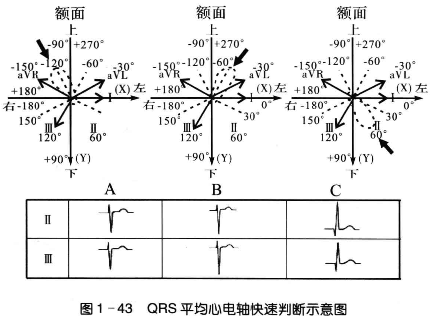 图1-43 qrs 平均心电轴快速判断示意图