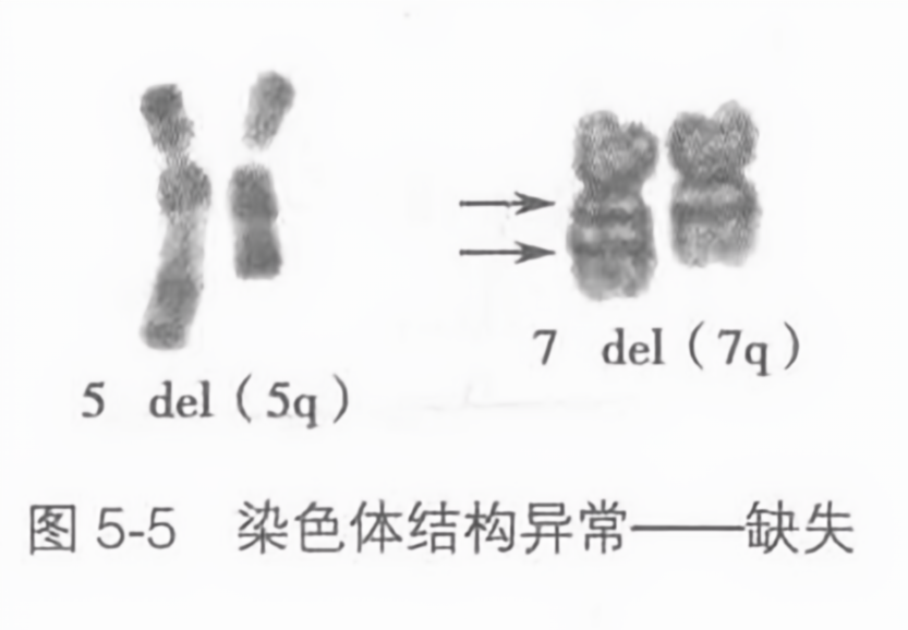 染色体结构异常--缺失