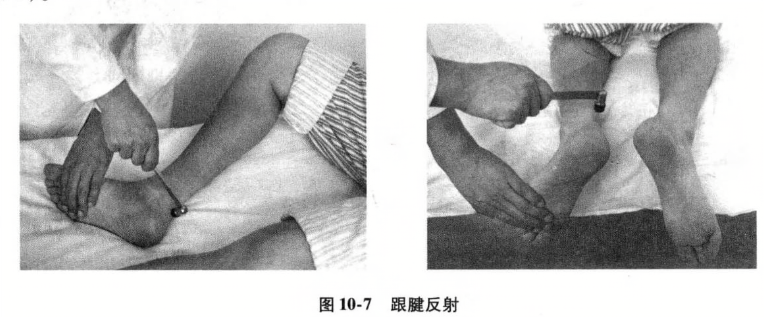 跟腱反射